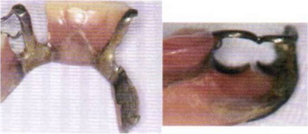 腐食して壊れた義歯