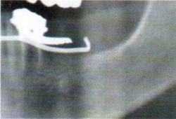 レントゲン写真