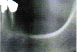 レントゲン写真