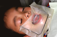 ラバーダム防湿法