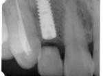 埋入直後のレントゲン