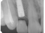 埋入直後のレントゲン