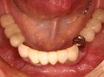 術後口腔内写真